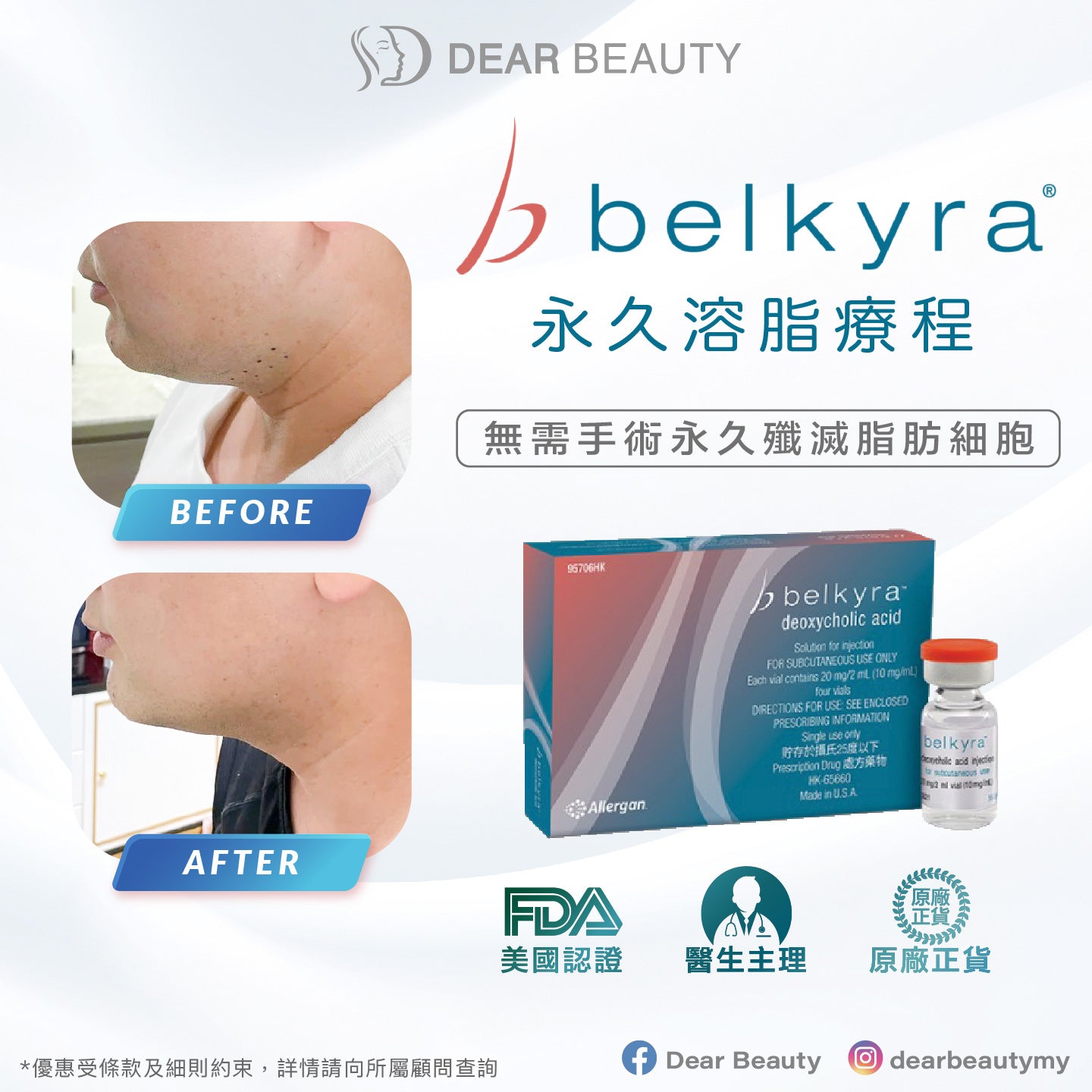 〖新客戶專享〗Belkyra 永久溶脂療程 2ml - 1次